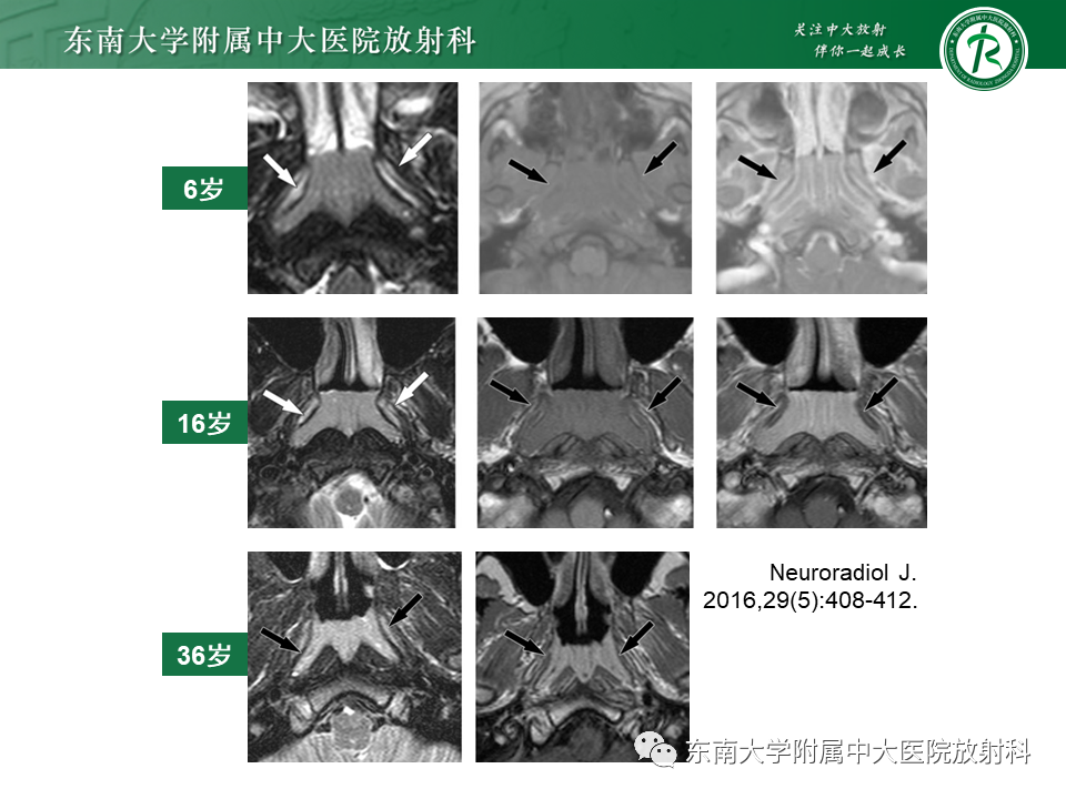 影像PPT - 【PPT】鼻咽部占位性病变随访及鉴别-69