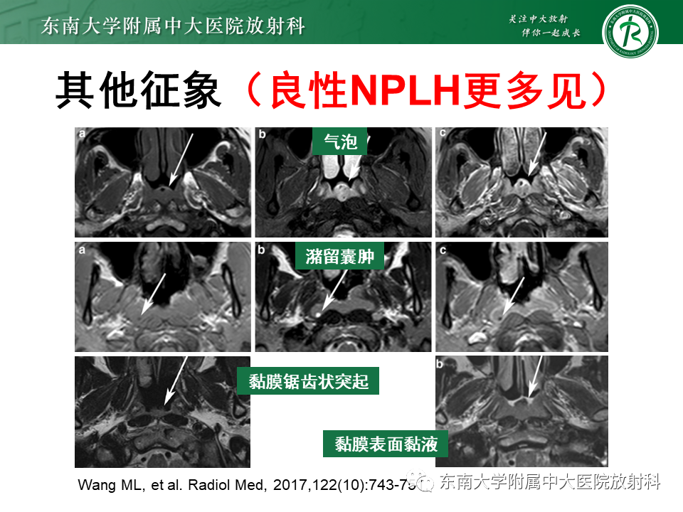 影像PPT - 【PPT】鼻咽部占位性病变随访及鉴别-71