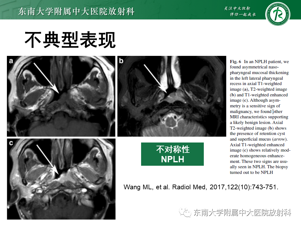 影像PPT - 【PPT】鼻咽部占位性病变随访及鉴别-72