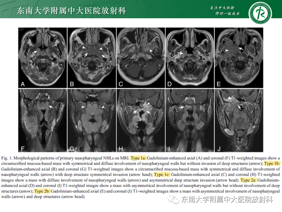 影像PPT - 【PPT】鼻咽部占位性病变随访及鉴别-76