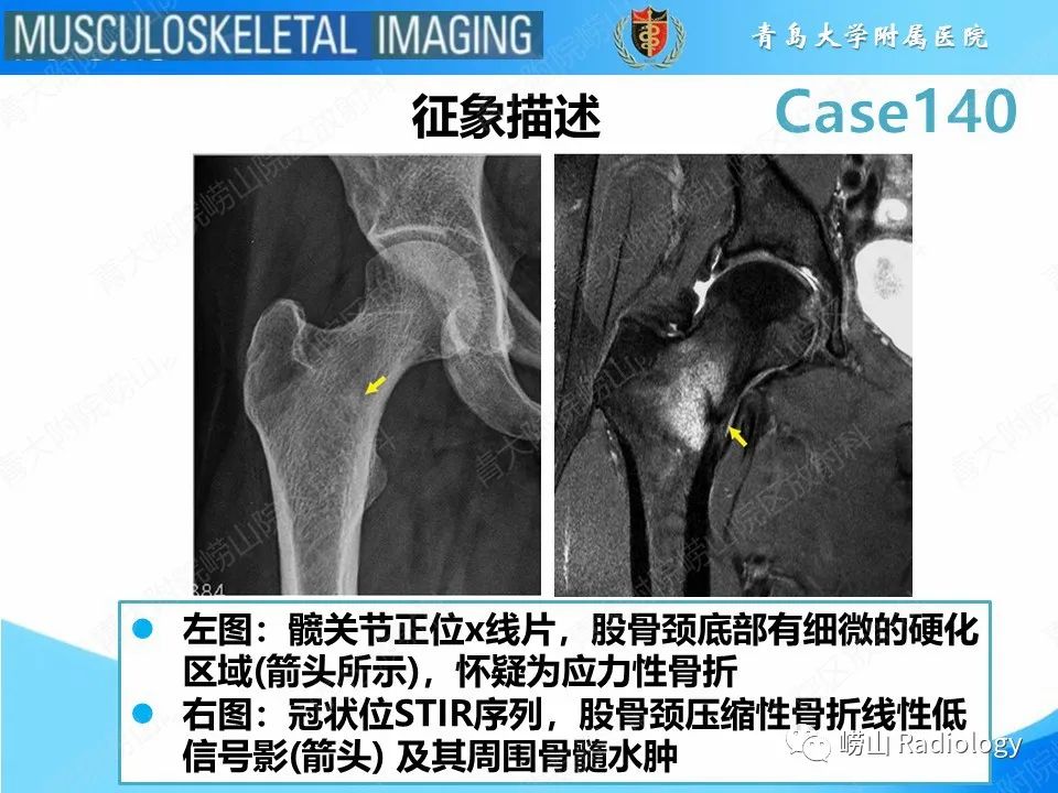 影像PPT - 【PPT】股骨颈应力性骨折-7