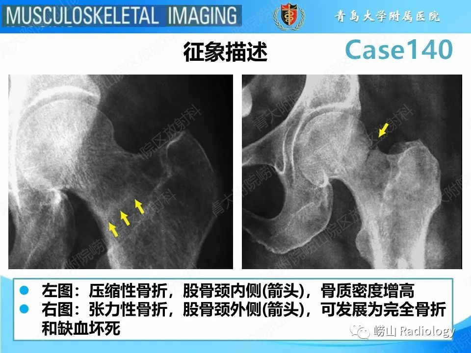 影像PPT - 【PPT】股骨颈应力性骨折-8