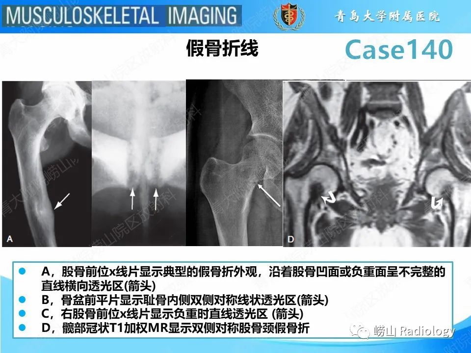 影像PPT - 【PPT】股骨颈应力性骨折-6