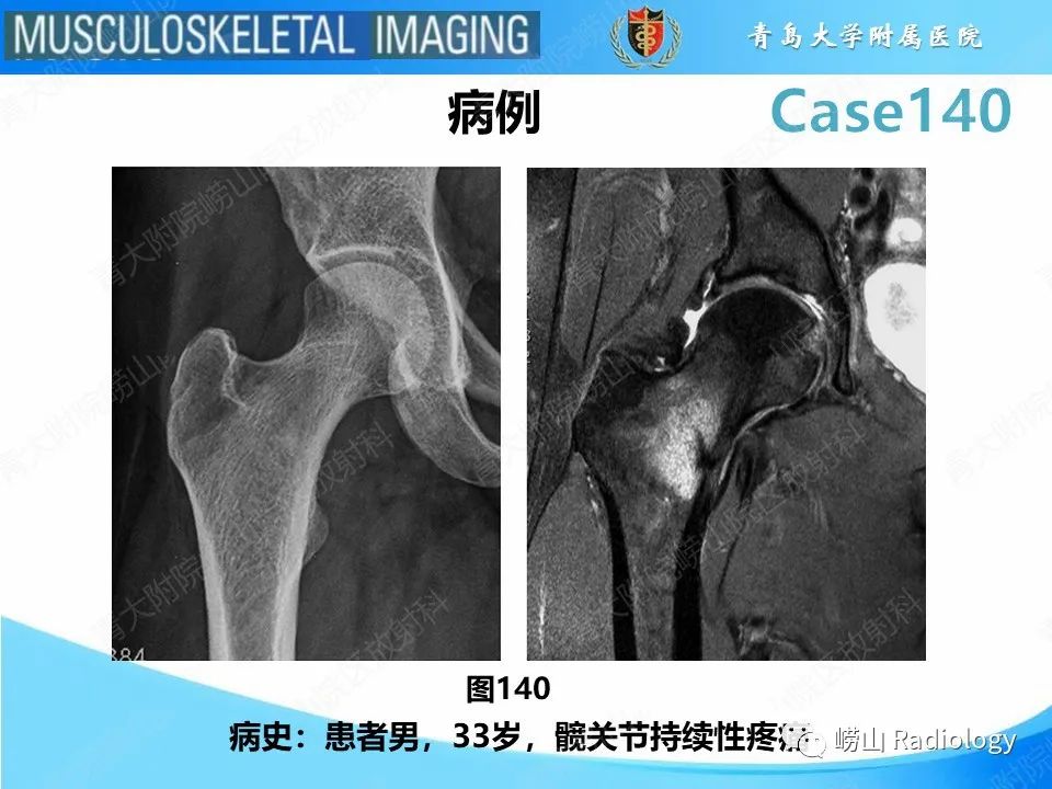 影像PPT - 【PPT】股骨颈应力性骨折-2