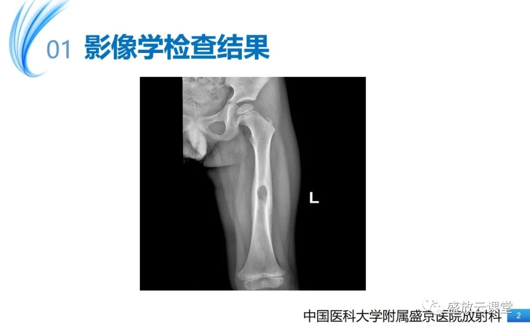 影像PPT - 【PPT】骨嗜酸性肉芽肿-2