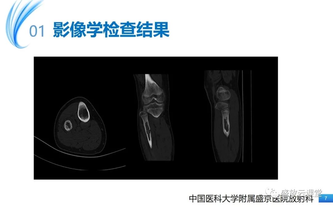 影像PPT - 【PPT】骨嗜酸性肉芽肿-7