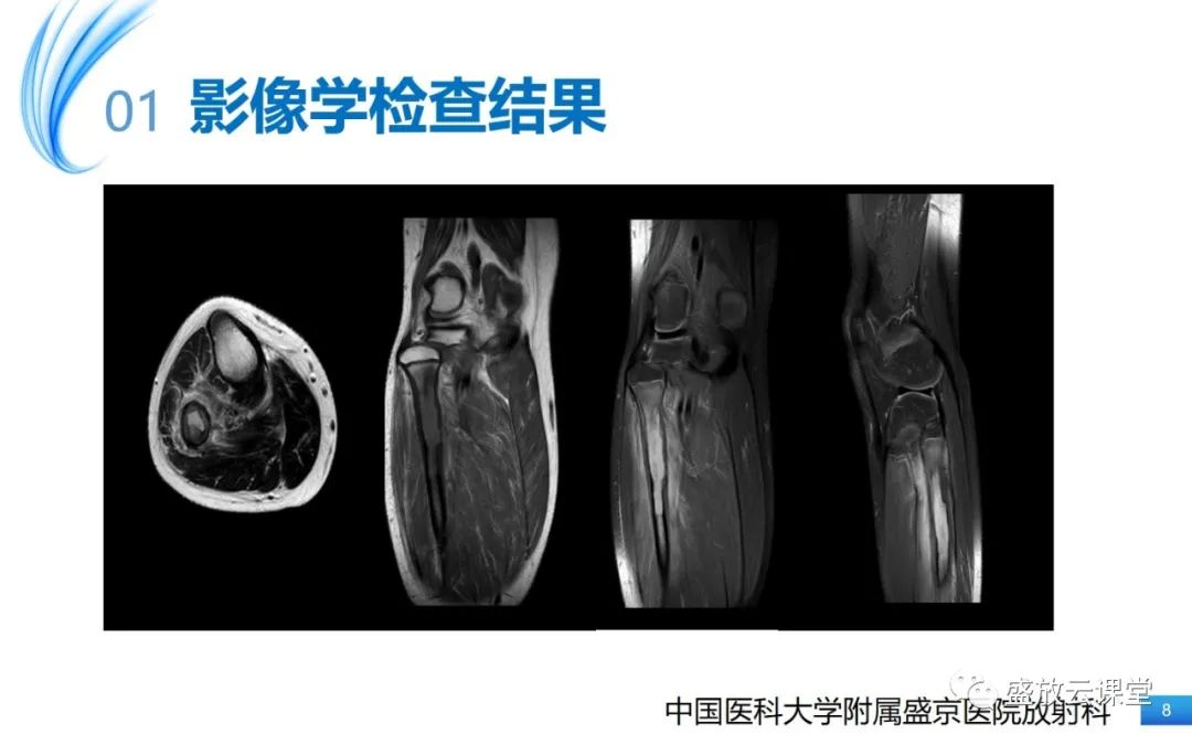 影像PPT - 【PPT】骨嗜酸性肉芽肿-8