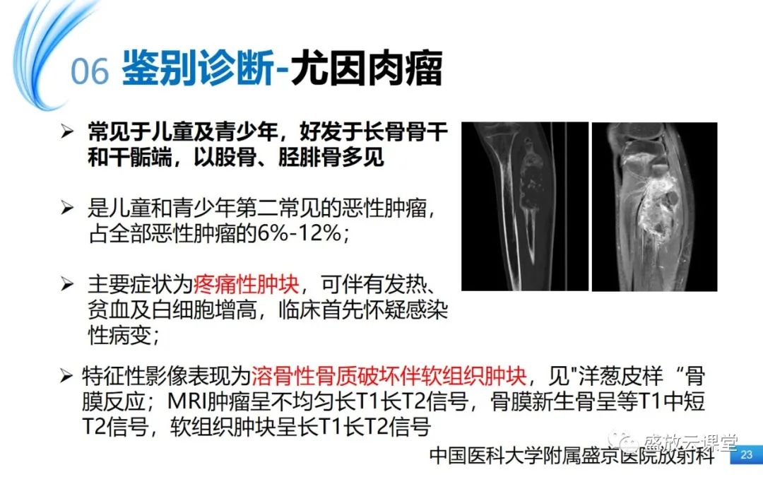 影像PPT - 【PPT】骨嗜酸性肉芽肿-23