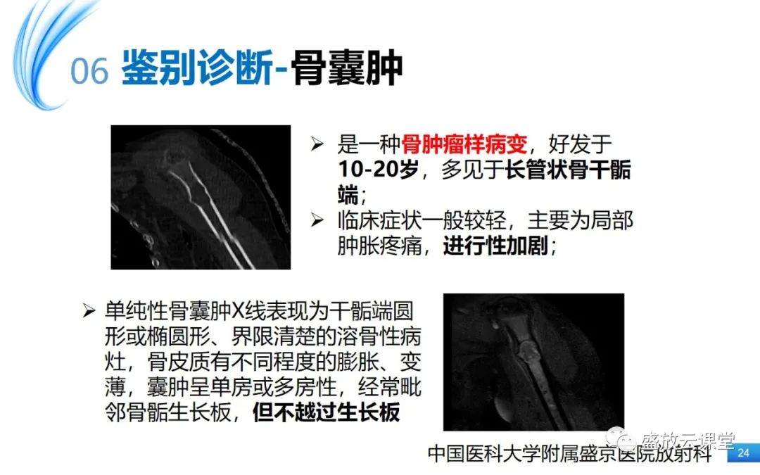 影像PPT - 【PPT】骨嗜酸性肉芽肿-24