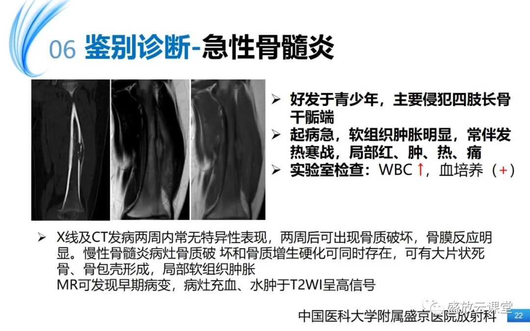 影像PPT - 【PPT】骨嗜酸性肉芽肿-22