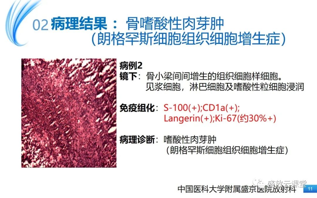 影像PPT - 【PPT】骨嗜酸性肉芽肿-11