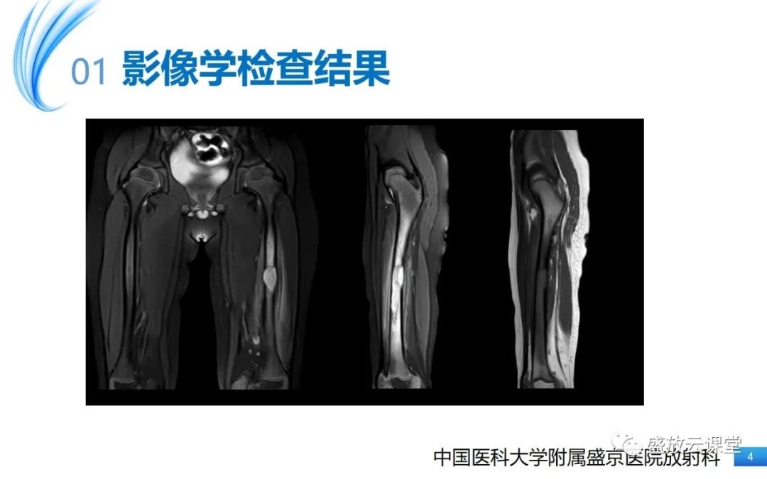 影像PPT - 【PPT】骨嗜酸性肉芽肿-4