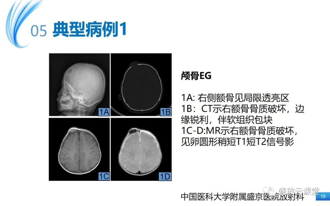影像PPT - 【PPT】骨嗜酸性肉芽肿-19