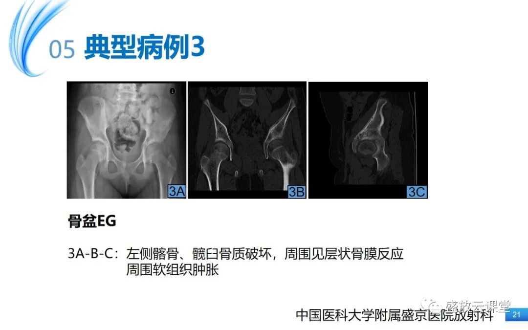 影像PPT - 【PPT】骨嗜酸性肉芽肿-21