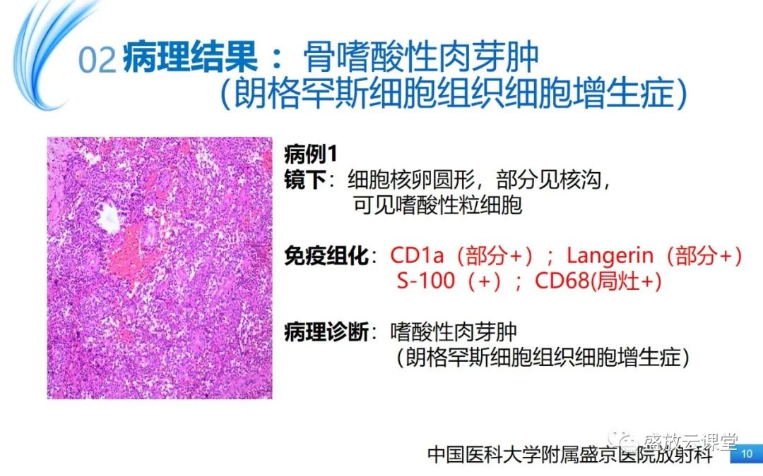 影像PPT - 【PPT】骨嗜酸性肉芽肿-10