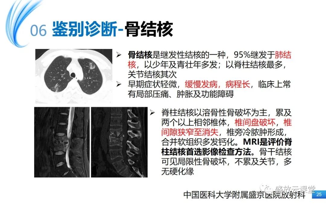 影像PPT - 【PPT】骨嗜酸性肉芽肿-25