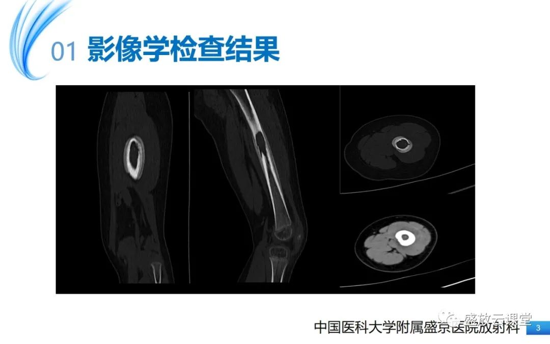 影像PPT - 【PPT】骨嗜酸性肉芽肿-3