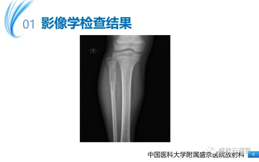 影像PPT - 【PPT】骨嗜酸性肉芽肿-6