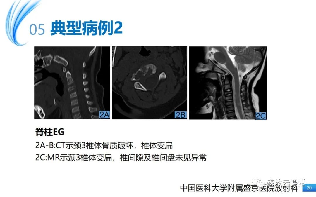 影像PPT - 【PPT】骨嗜酸性肉芽肿-20