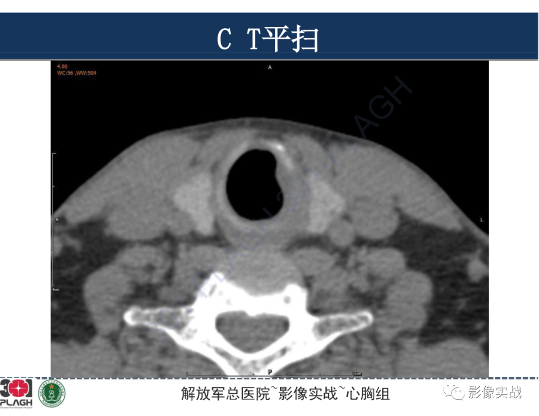 影像PPT - 【病例】气管腺样囊性癌1例CT及MR-9