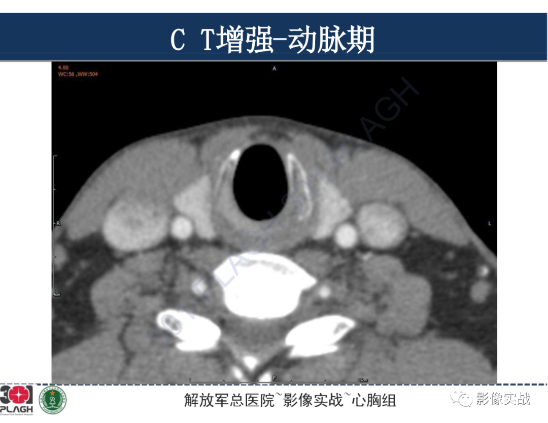影像PPT - 【病例】气管腺样囊性癌1例CT及MR-10