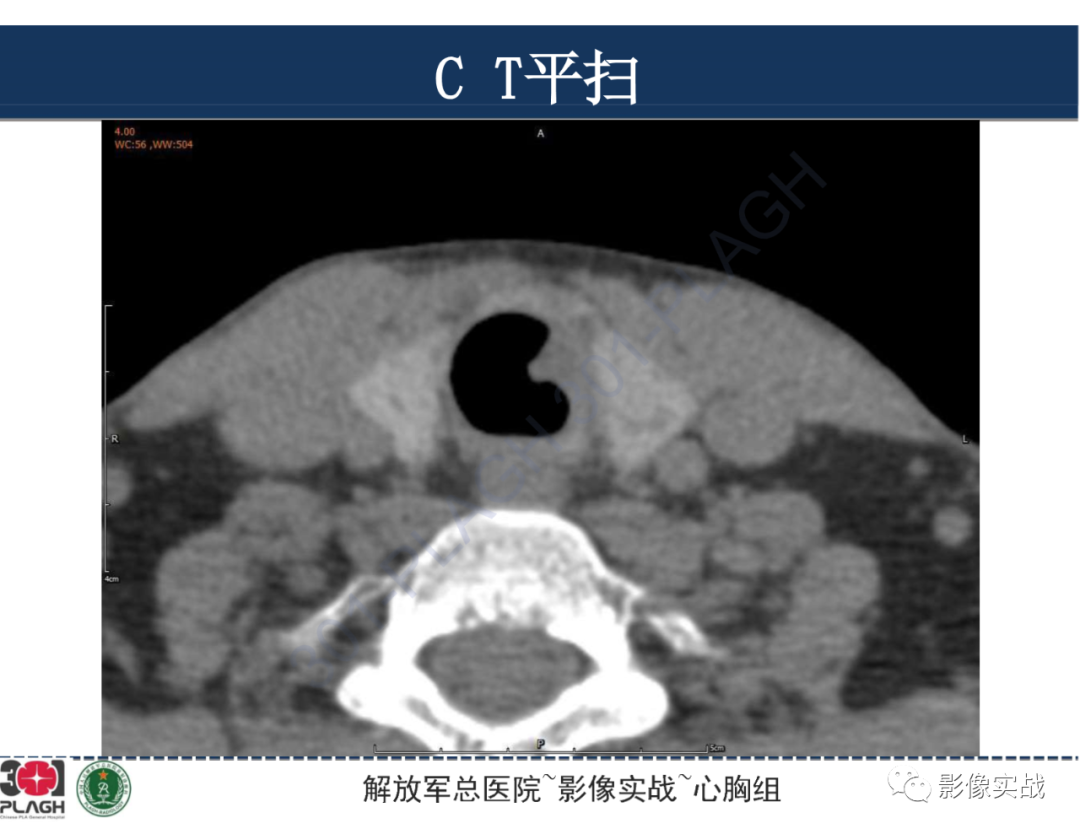 影像PPT - 【病例】气管腺样囊性癌1例CT及MR-7