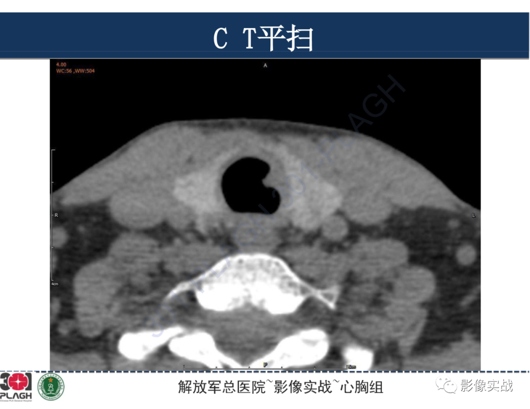影像PPT - 【病例】气管腺样囊性癌1例CT及MR-6
