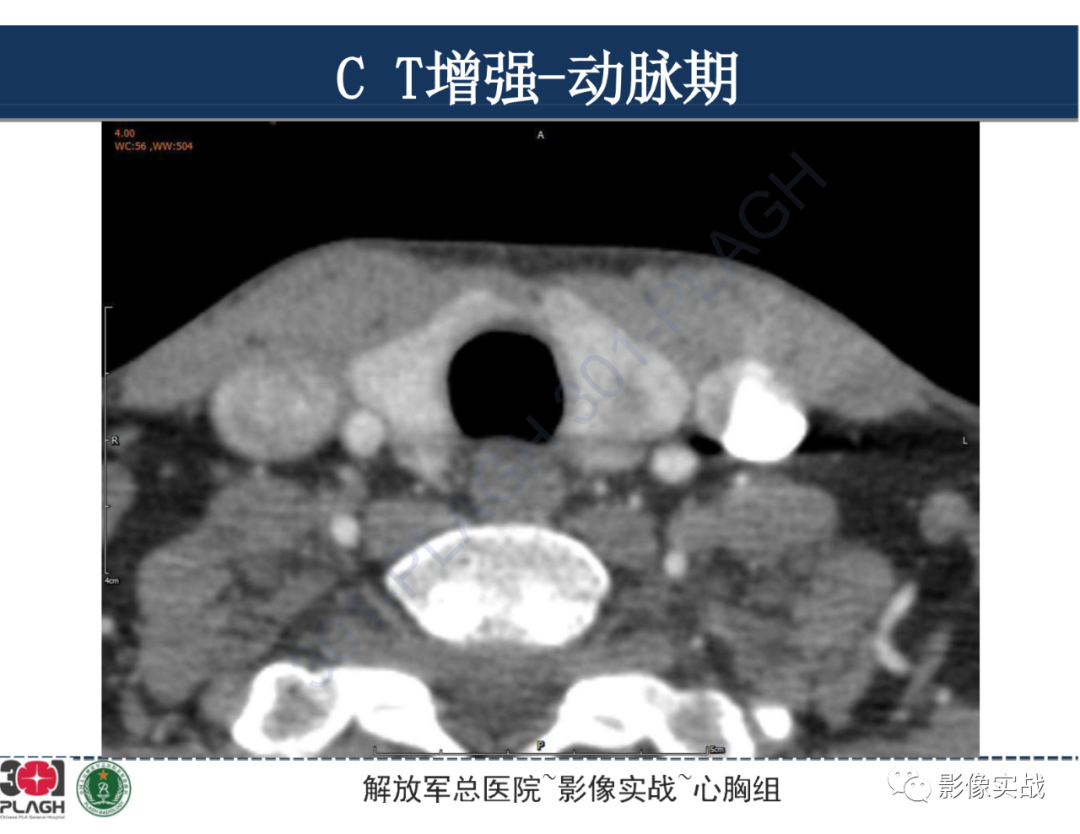 影像PPT - 【病例】气管腺样囊性癌1例CT及MR-11