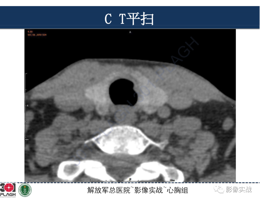 影像PPT - 【病例】气管腺样囊性癌1例CT及MR-5