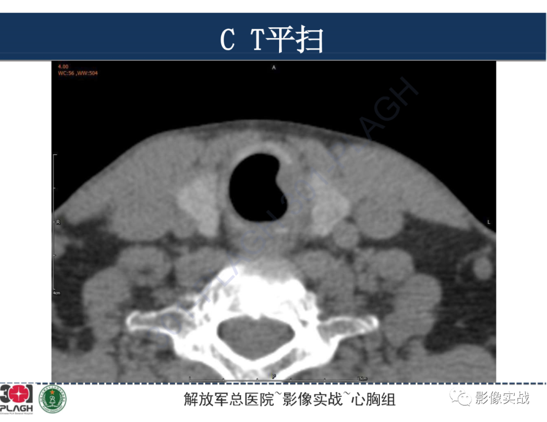 影像PPT - 【病例】气管腺样囊性癌1例CT及MR-8