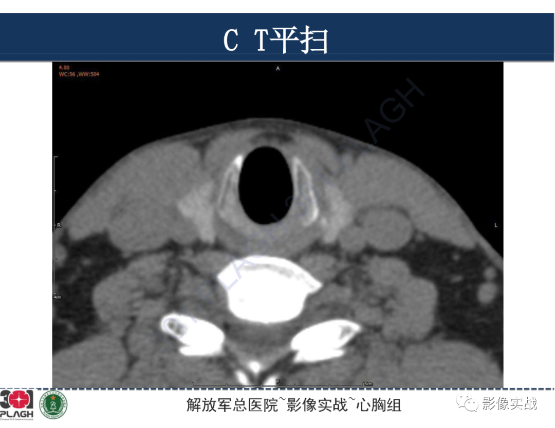 影像PPT - 【病例】气管腺样囊性癌1例CT及MR-3