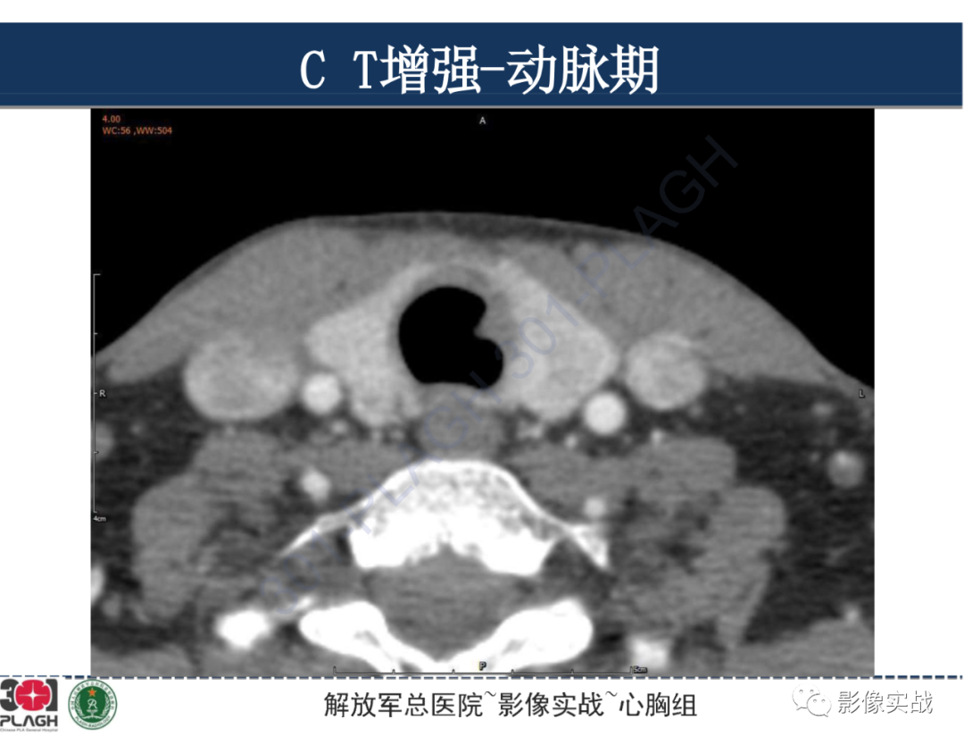 影像PPT - 【病例】气管腺样囊性癌1例CT及MR-13