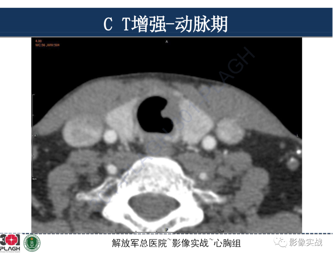 影像PPT - 【病例】气管腺样囊性癌1例CT及MR-14
