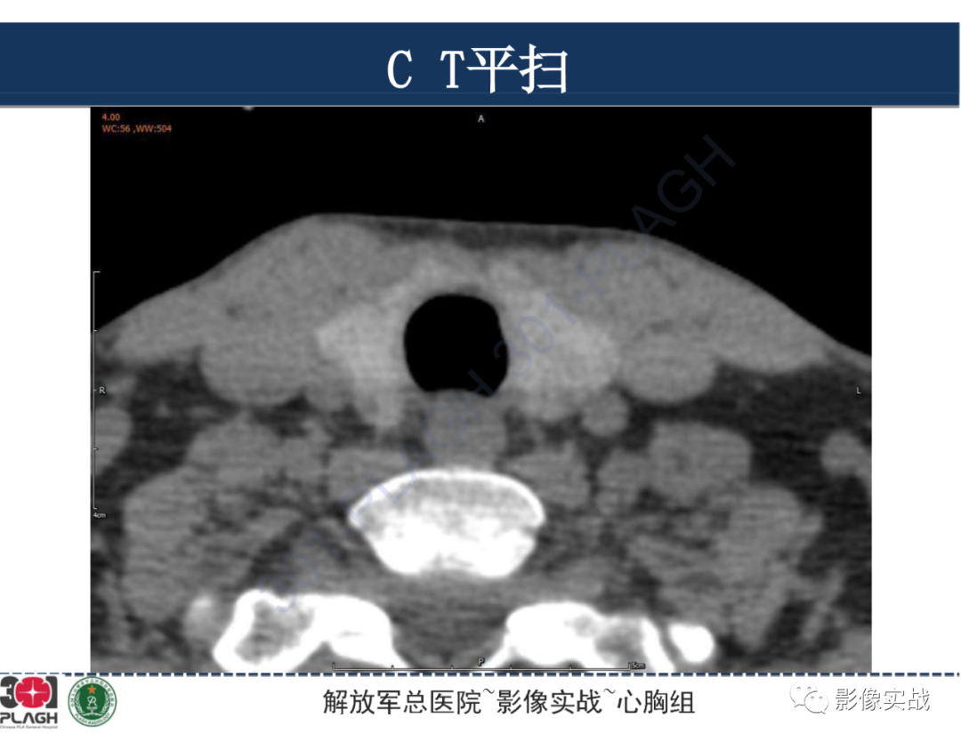 影像PPT - 【病例】气管腺样囊性癌1例CT及MR-4