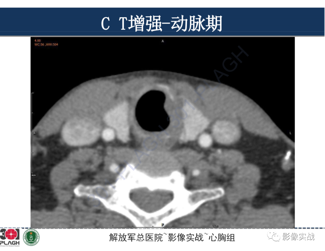 影像PPT - 【病例】气管腺样囊性癌1例CT及MR-16