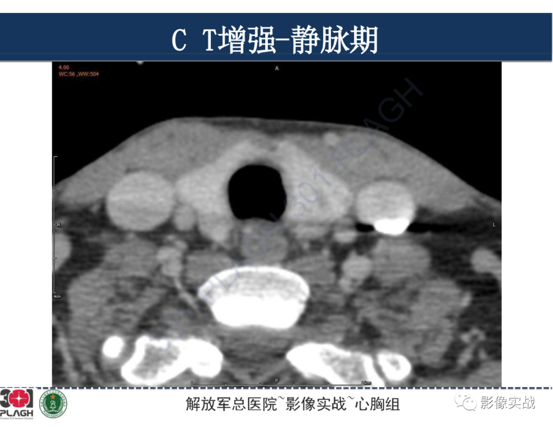 影像PPT - 【病例】气管腺样囊性癌1例CT及MR-18
