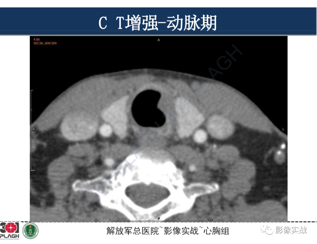 影像PPT - 【病例】气管腺样囊性癌1例CT及MR-15