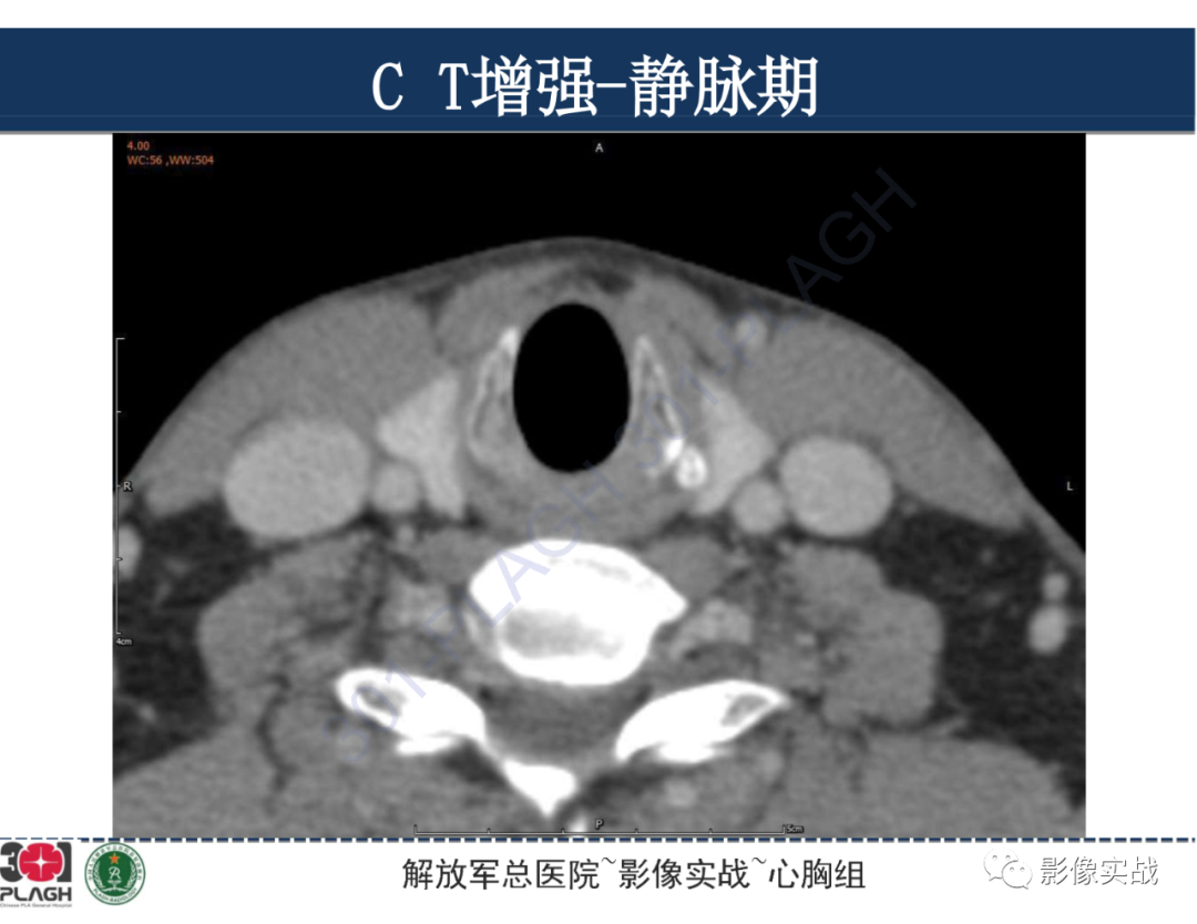 影像PPT - 【病例】气管腺样囊性癌1例CT及MR-17