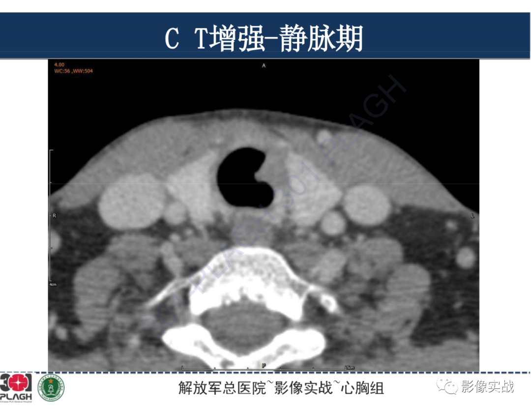 影像PPT - 【病例】气管腺样囊性癌1例CT及MR-21