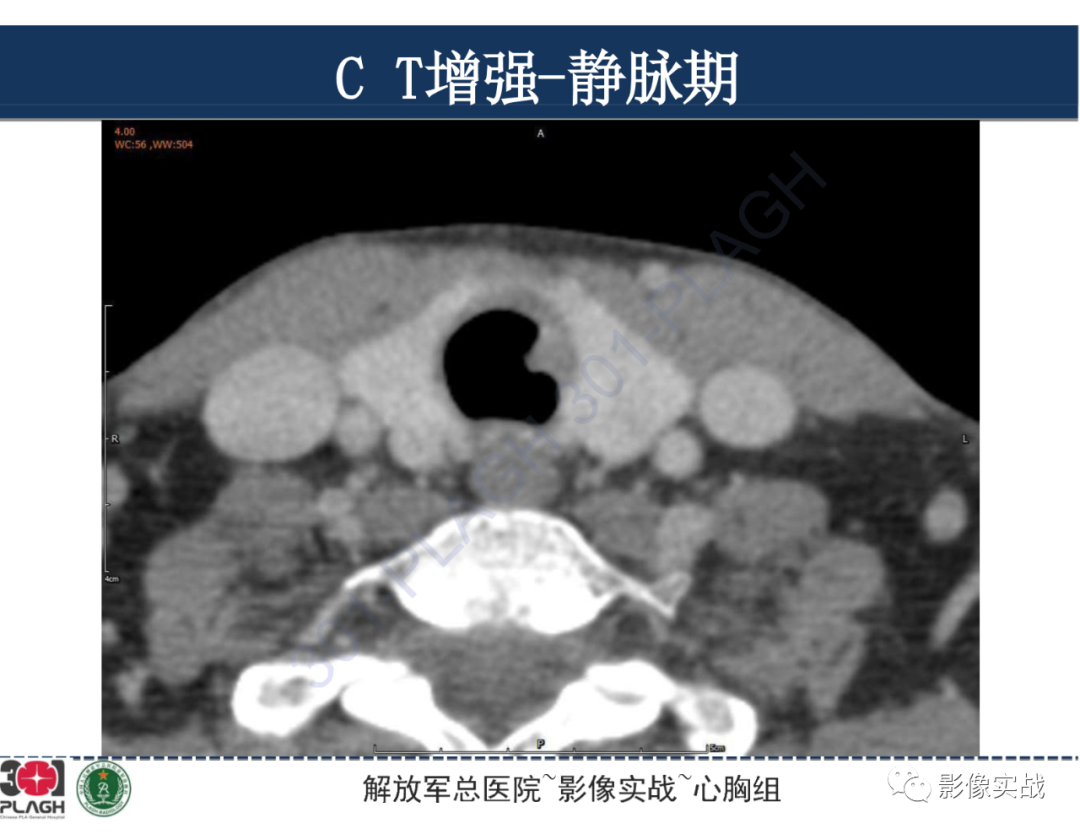 影像PPT - 【病例】气管腺样囊性癌1例CT及MR-20