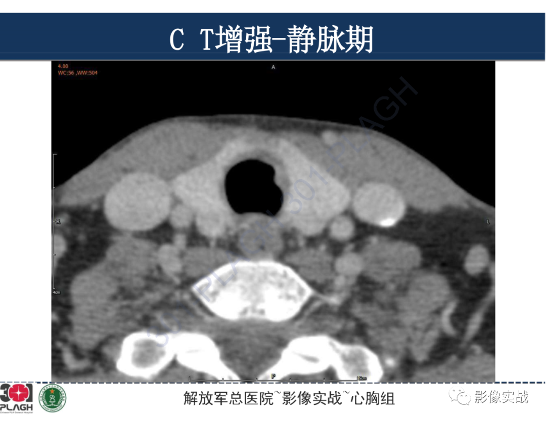 影像PPT - 【病例】气管腺样囊性癌1例CT及MR-19