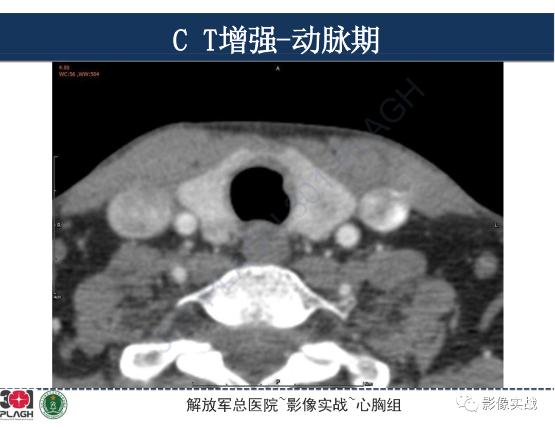 影像PPT - 【病例】气管腺样囊性癌1例CT及MR-12