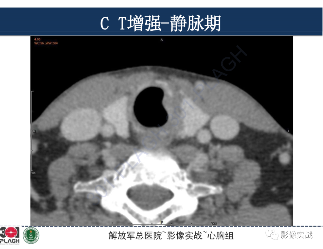 影像PPT - 【病例】气管腺样囊性癌1例CT及MR-22
