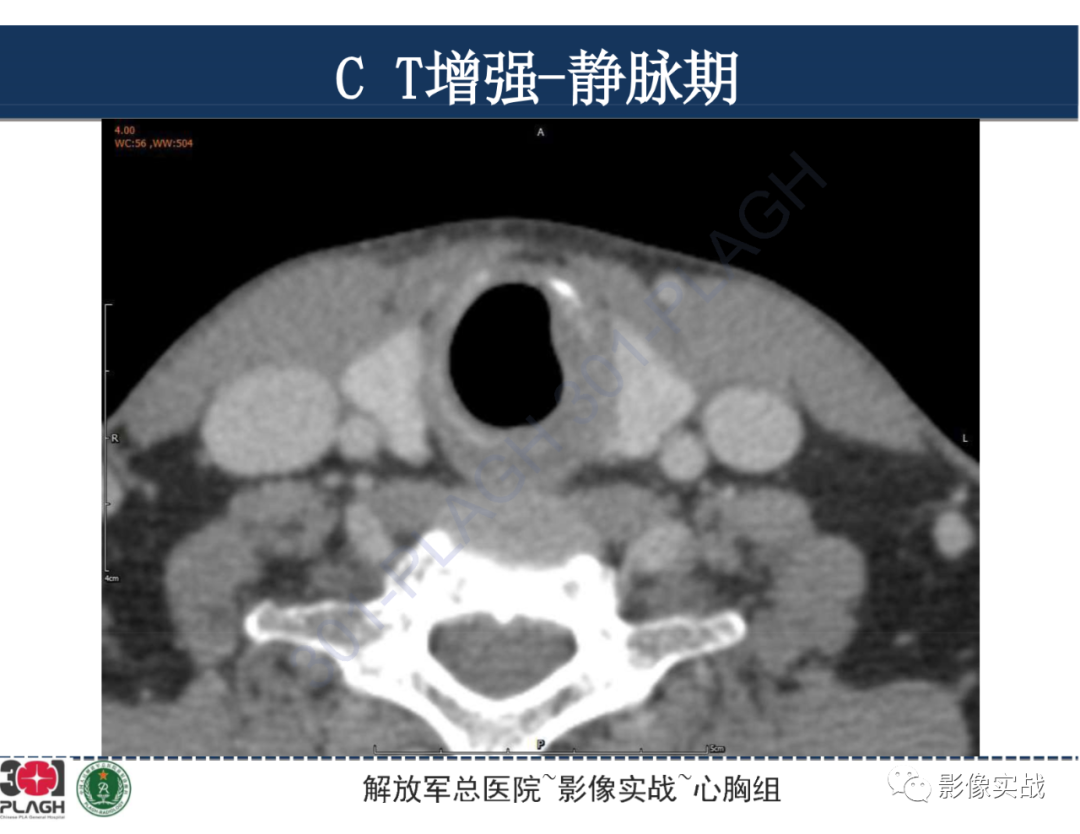 影像PPT - 【病例】气管腺样囊性癌1例CT及MR-23