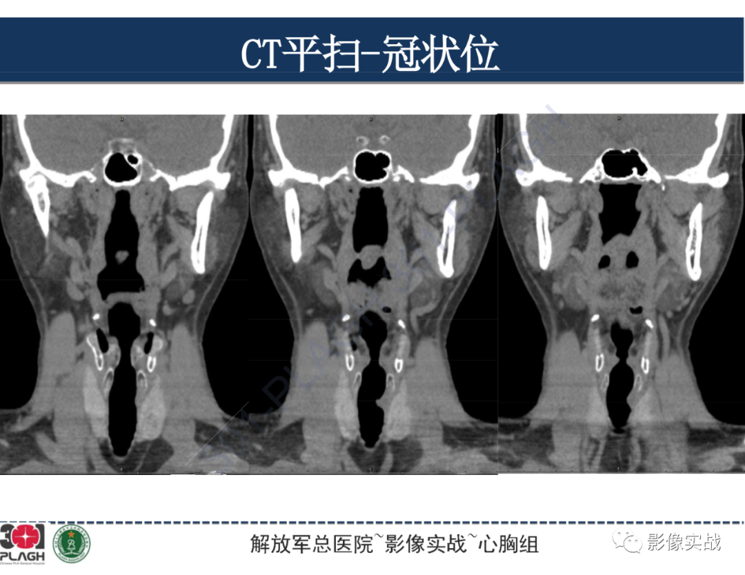 影像PPT - 【病例】气管腺样囊性癌1例CT及MR-24