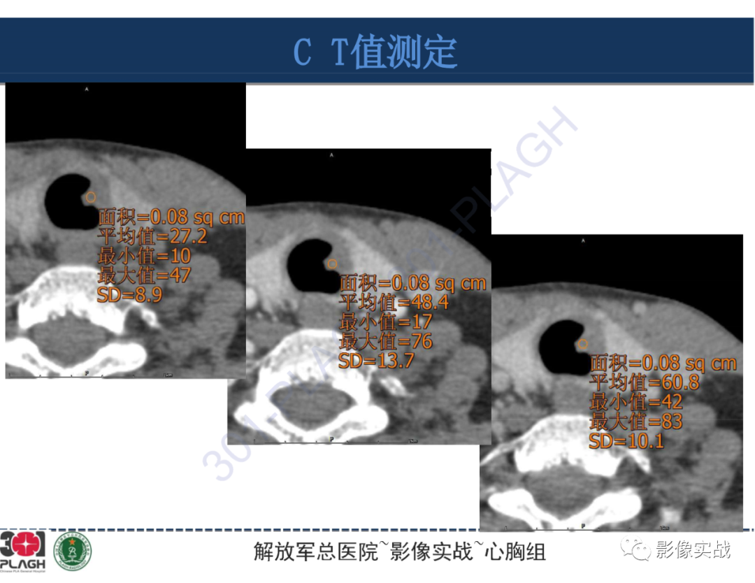 影像PPT - 【病例】气管腺样囊性癌1例CT及MR-25