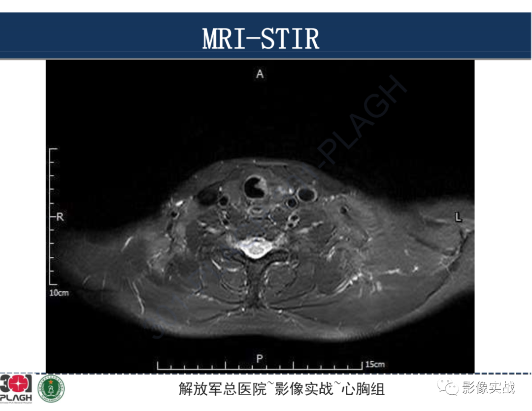 影像PPT - 【病例】气管腺样囊性癌1例CT及MR-26