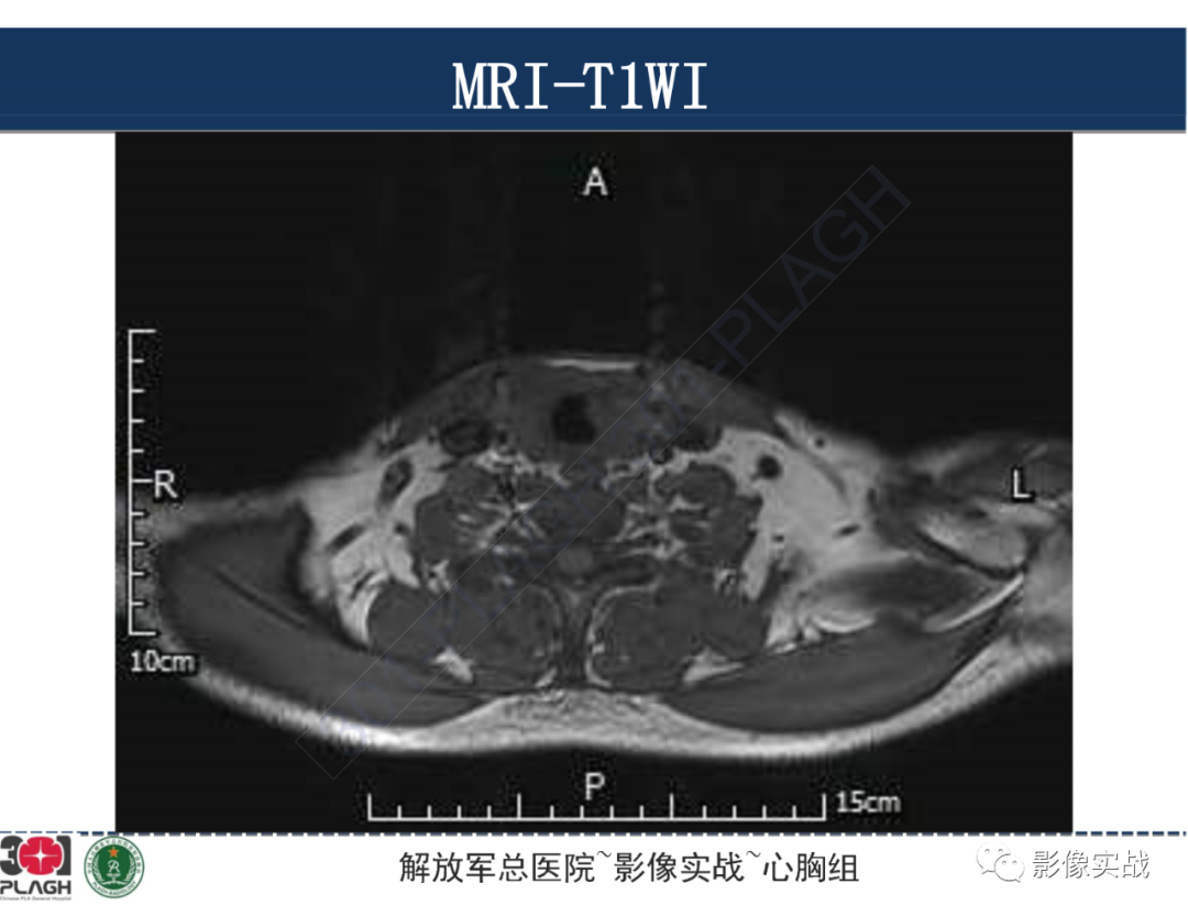 影像PPT - 【病例】气管腺样囊性癌1例CT及MR-27