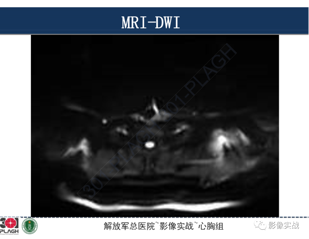 影像PPT - 【病例】气管腺样囊性癌1例CT及MR-28