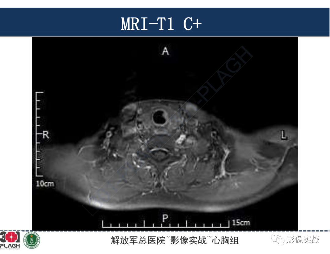 影像PPT - 【病例】气管腺样囊性癌1例CT及MR-29